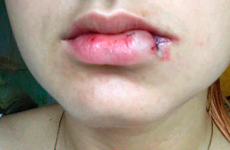 Жительнице Клина порвали губу в стоматологической клинике