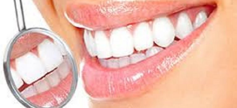 Отбеливание зубов: как не навредить своей улыбке